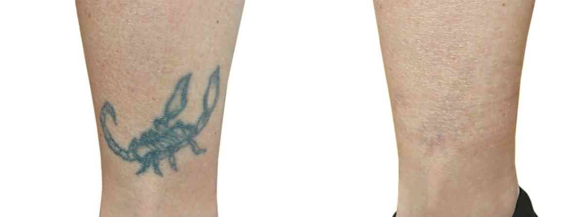 efekty laserowego usuwania tatuażu